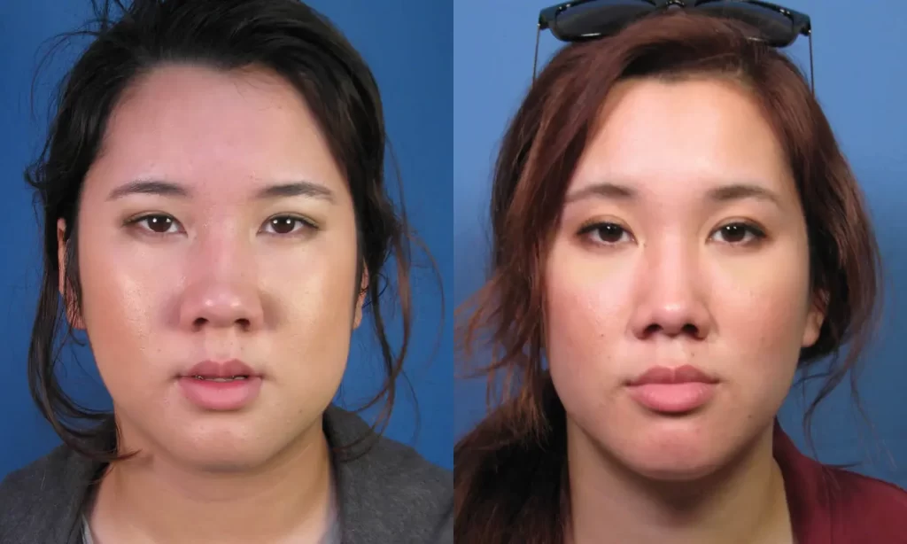 Front view of the face of a female Asian patient before and after Asian nose job