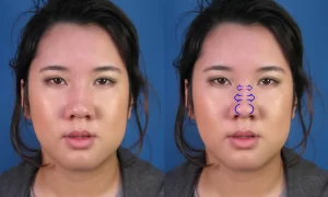 Side-by-side comparison of an Asian woman's nose without and with blue arrows indicating poorly defined nose bridge and rounded tip.