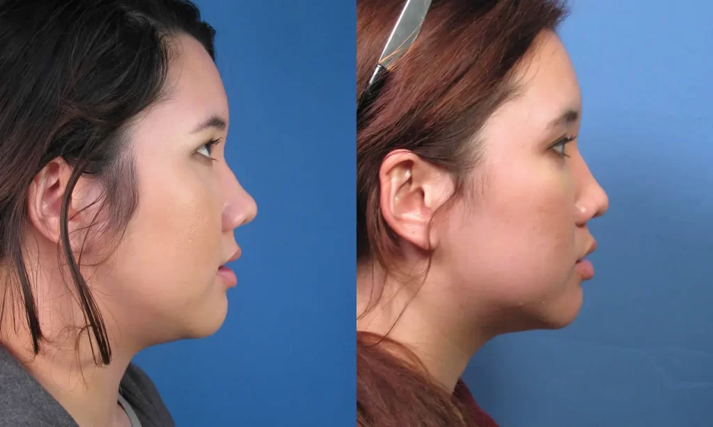 Lateral view of the face of a female Asian patient before and after Asian nose job 