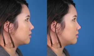 Side-by-side comparison of an Asian woman's  profile without and with blue arrows indicating poorly defined nasal tip