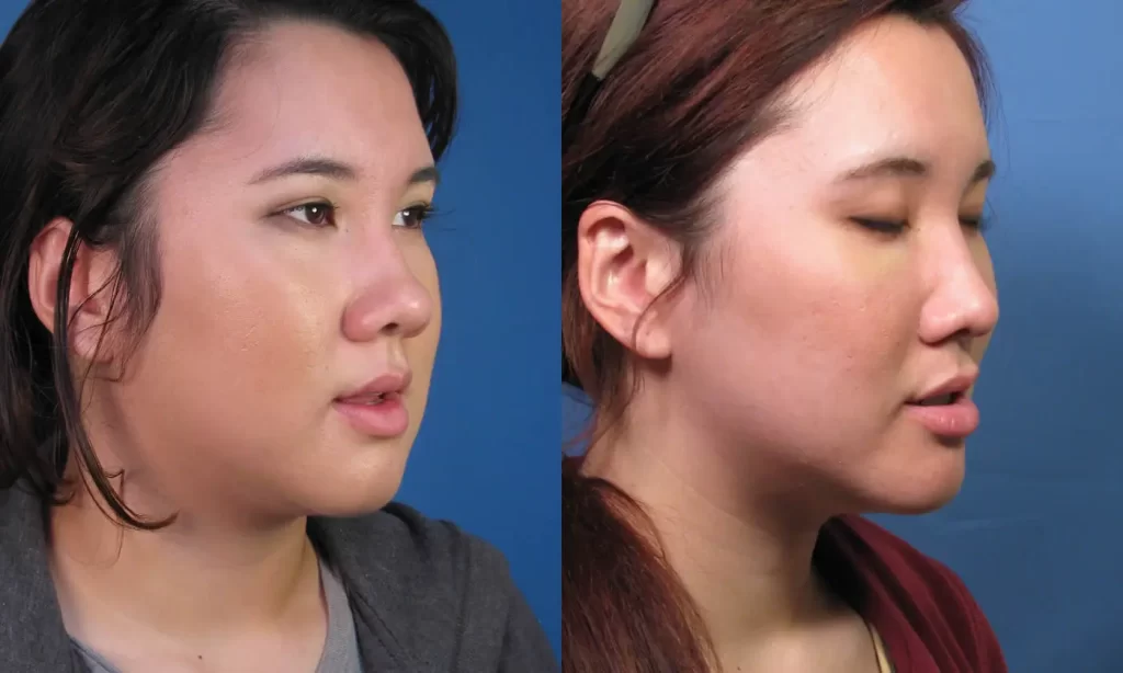 Oblique view of the face of a female Asian patient before and after Asian nose job 