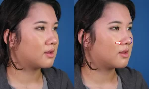 Side-by-side comparison of an Asian woman's profile without and with blue arrows indicating bulbous nasal tip