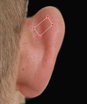 Close-up of an ear with a red rectangle and dots highlighted on the upper ear cartilage against a black background.