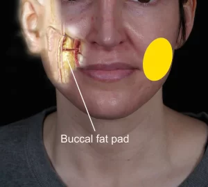 Image of a person's face with a labeled diagram showing the buccal fat pad location. The left side is partially transparent to display internal anatomy.