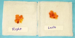 Two pieces of gauze labeled "Right" and "Left," each with a small amount of tissue or material on them, placed on a blue background.