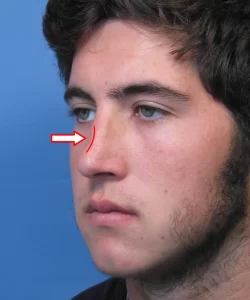 Profile of a person with a red arrow pointing at their nose, showing a marked curve. Blue background.