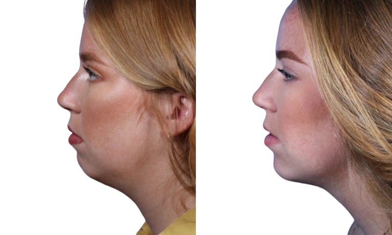 Side-by-side profile photos of a person before and after a cosmetic procedure, showing facial changes.