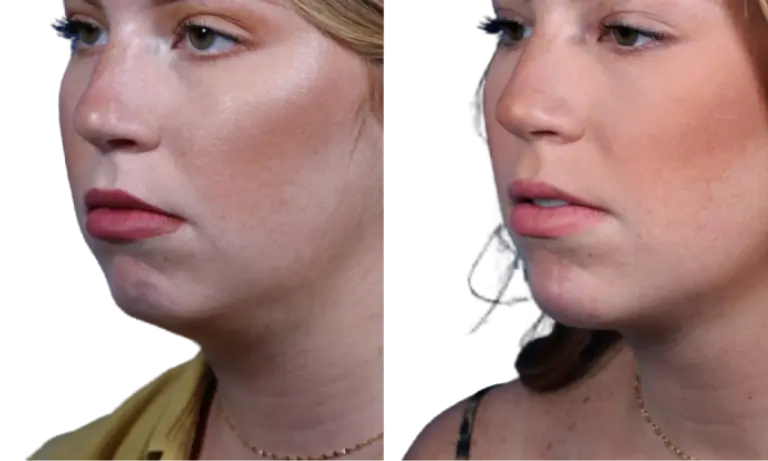 Side-by-side images of a woman's profile before and after a cosmetic change, showing differences in chin shape and skin tone.