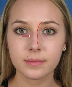 A person with a red line marking a curved path from the forehead to the nose, next to an arrow pointing left at the nose.