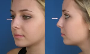 Side-by-side images showing a woman's profile and front view with arrows indicating the nasal area.