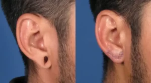 Side-by-side comparison of a person's ear before and after earlobe repair surgery. The left shows a stretched earlobe with a large gauge, and the right shows a healed earlobe with sutures.