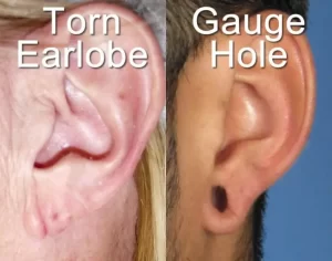 Close-up images of two earlobes. Left: a torn earlobe. Right: an earlobe with a gauge hole.