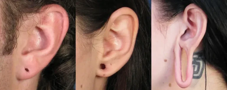 A series of images shows a person’s ear undergoing progressive earlobe stretching, with an increasingly larger gauge size, ending with a significantly stretched earlobe.