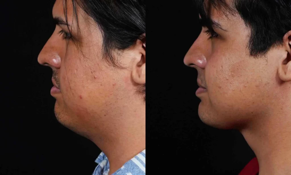 Side-by-side profile images of a person before (left) and after (right) a cosmetic procedure, highlighting changes in jawline and skin appearance against a black background.