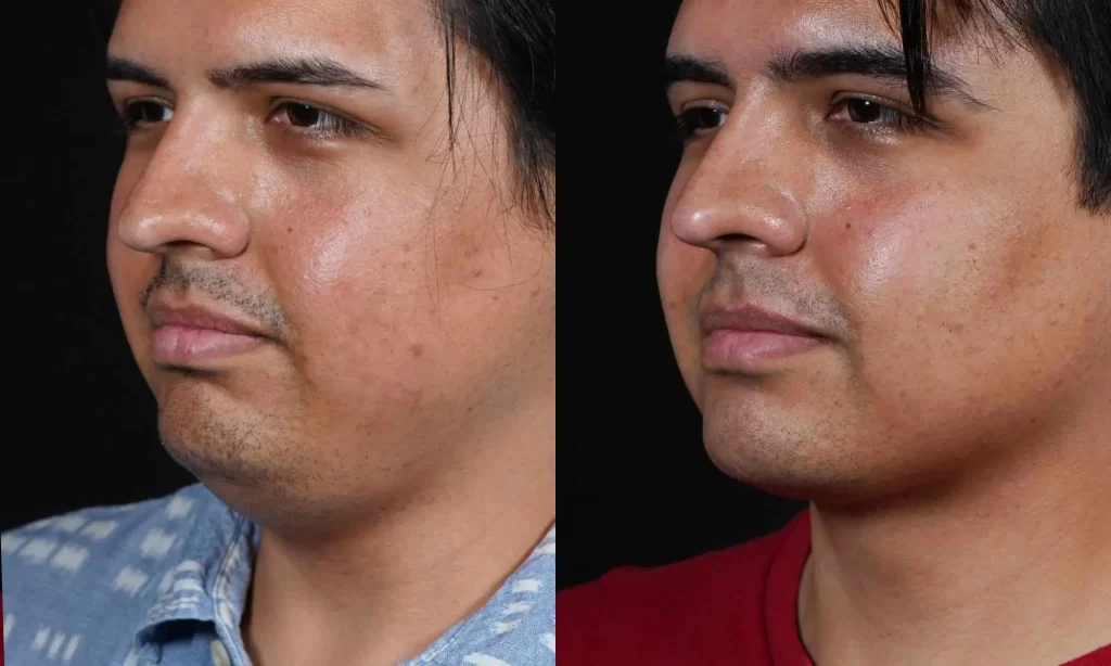 Side-by-side comparison of a man's face, showing a before and after view of his lower face and neck, with visible changes in skin texture and contour.