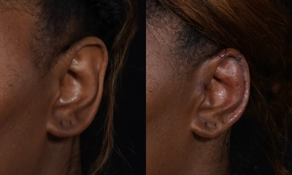 Close-up of a person's ear before and after otoplasty surgery, showing reshaping and repositioning.