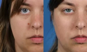 Side-by-side comparison of a woman's face before and after a facial mole removal. The "before" image shows a mole on her left cheek, while the "after" image shows clear skin.