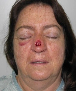 A woman with a red lesion on her nose and a bruise under her right eye, eyes closed, wearing a striped garment.