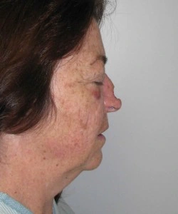 Profile view of a woman with a bruised eye and noticeable nose shape against a plain background.