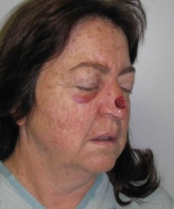 A woman with a bruised cheek and a red, scabbed area on her nose.