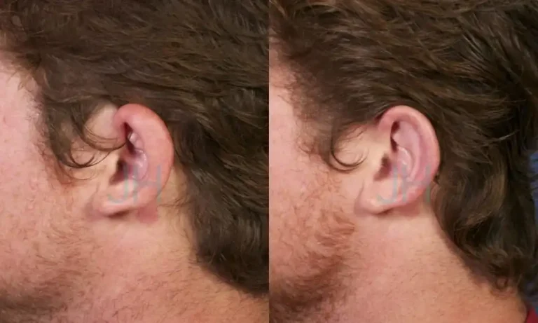 Side-by-side comparison of a person's left ear before and after a cosmetic procedure. The left image shows a more protruding ear, while the right image shows the ear closer to the head.