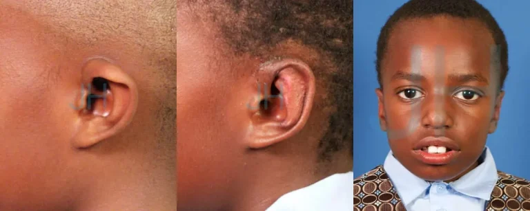 The image shows three side-by-side photos: two close-ups of a child's ear from different angles and a front-facing portrait of the same child.