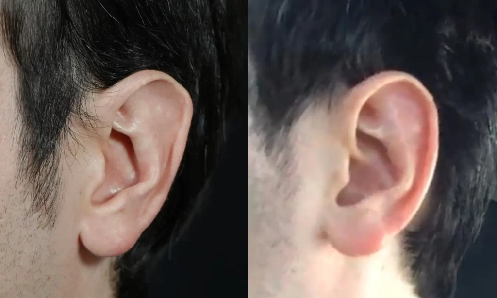 Close-up of two human ears, with different shapes and angles, against a dark background.