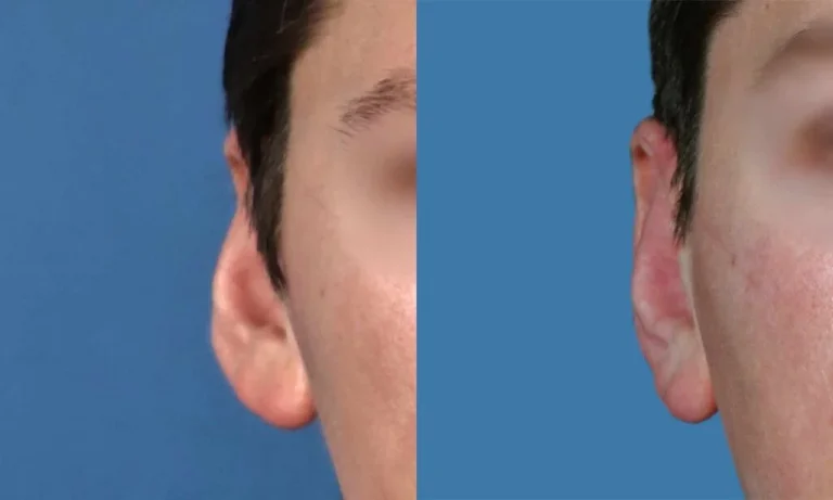 Side-by-side comparison of an ear before and after surgery, showing noticeable changes in the ear's shape and position against a blue background.