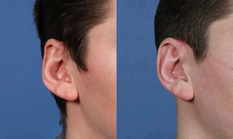 Side-by-side comparison of a person's ear before and after ear reshaping surgery against a blue background.