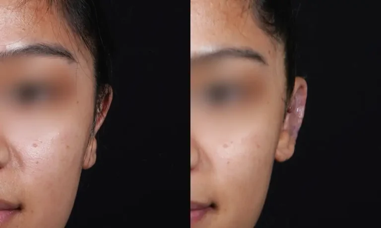 Side-by-side image comparing the front view of a person's face before and after otoplasty, showing noticeable changes to the ear's position.