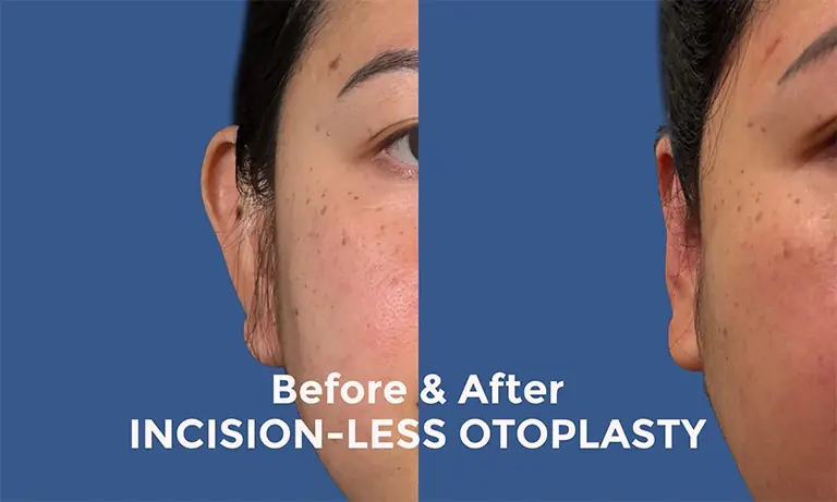 Before and after comparison of incision-less otoplasty shows changes in ear appearance.