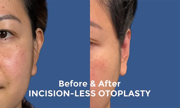 Side-by-side comparison showing a face before and after incision-less otoplasty, with noticeable ear position adjustment.