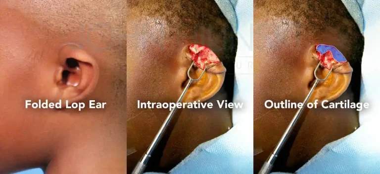 Three-step surgical illustration of correcting a folded lop ear: side view, intraoperative view showing cartilage, and an outlined cartilage view.