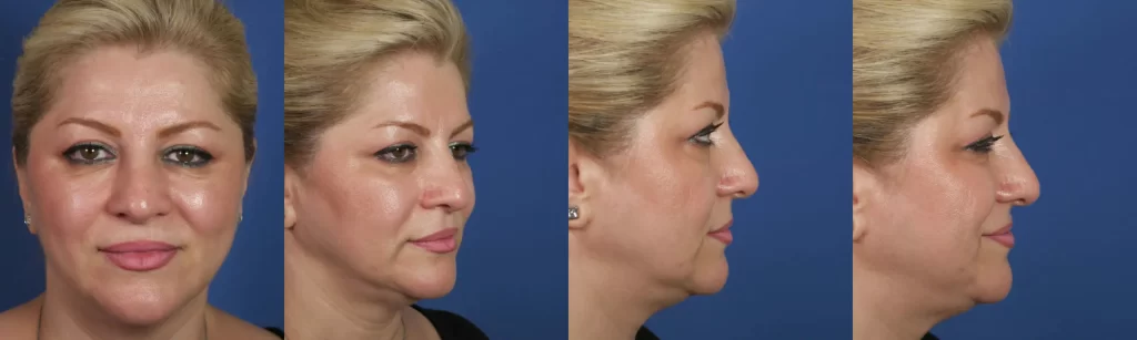 Side-by-side comparison of a person's face, front and side view, showing changes. Blue background.