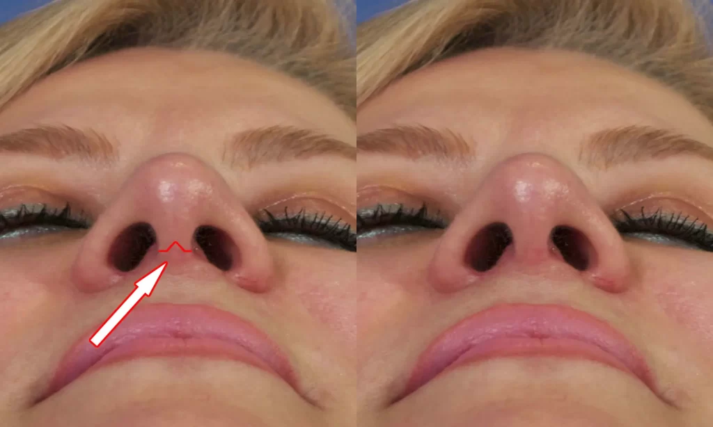 Close-up of a person's nose before and after a procedure. The left side shows a deviated septum with an arrow pointing to it; the right side shows a corrected septum.