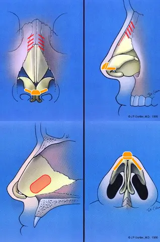 Illustrated diagrams showing the anatomy of the nasal structure from different angles, highlighting bones and cartilage.