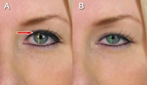 Close-up of two eyes labeled A and B. A red arrow in A points to the corner of the eye, and vertical lines run through both pupils.