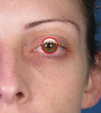 A close-up of an eye with a red circle around the pupil and yellow dots marking the upper eyelid contour.