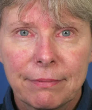 Close-up of a person's face with visible skin redness and light-colored eyes, looking directly at the camera. The background is blue.