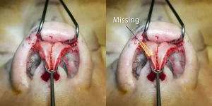 Side-by-side comparison of nasal surgery with cartilage exposed. Right side highlights a missing piece with text and markings.