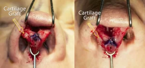 Close-up of a surgical procedure showing cartilage graft placement in a nose, with arrows pointing to the grafts on both the left and right images.