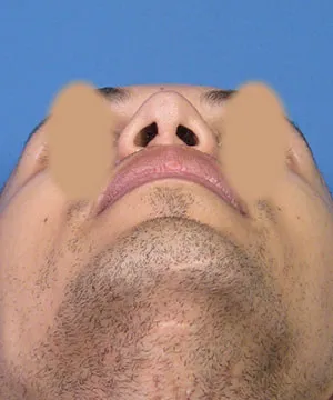 View of the male African-American patient's nose base after the rhinoplasty