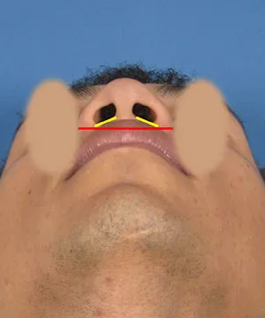 View of the male African-American patient's nose base, showing nostrils with a red and yellow line indicating measurement angles.