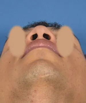 View of the male African-American patient's nose base before the rhinoplasty