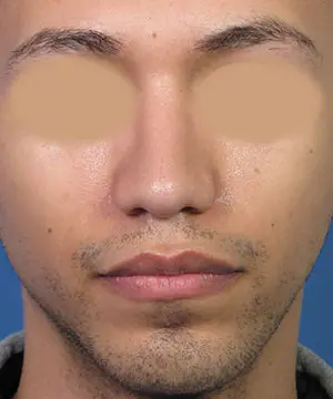 Front view of the face of a male African-American patient after the rhinoplasty