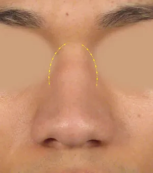 Close-up of a patient's nose with a dotted yellow line highlighting the bridge contour.