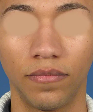 Front view of the face of a male African-American patient with wide nostril base before the rhinoplasty