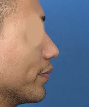 Lateral view of the face of a male African-American patient after the rhinoplasty