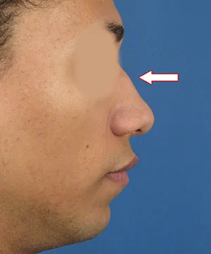 Profile view of a male African-American patient’s face against a blue background, with a red arrow pointing to the nose hump area.