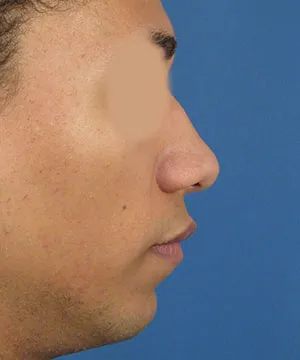 Lateral view of the face of a male African-American patient  with hump nose deformity before the rhinoplasty